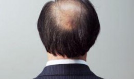 吃瓜吃多了会掉头发吗,揭秘日常饮食习惯与头发健康的关系