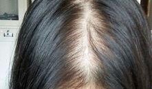 吃瓜吃多了会掉头发吗,揭秘日常饮食习惯与头发健康的关系